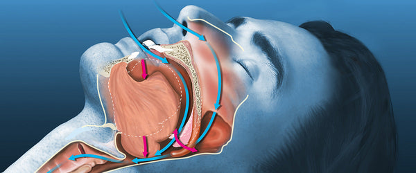 Illustration showing the cause of snoring